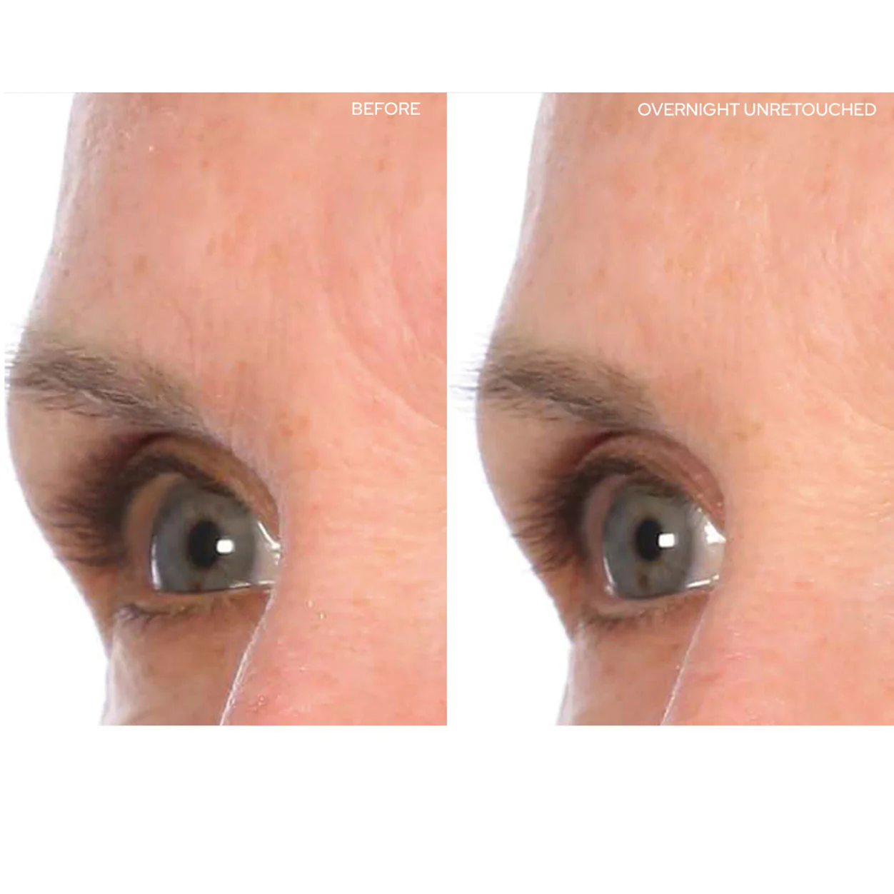 2594-browlift-2.webp BrowLift
